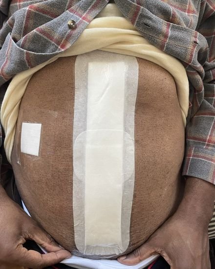 After — Post-operative wound care with regular monitoring and dressing changes.