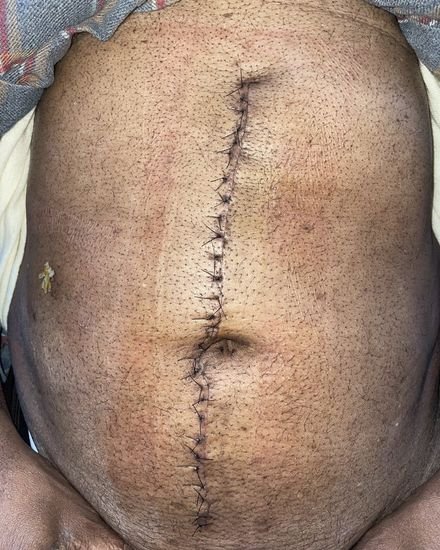 Before — Post-operative wound care with regular monitoring and dressing changes.