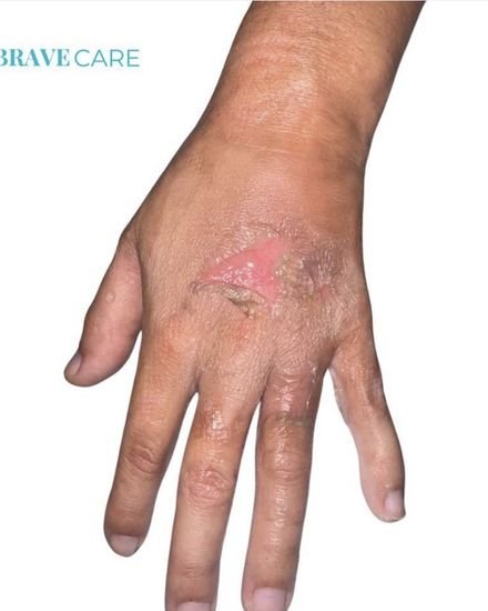 Before — Nursing care for a superficial second-degree burn, fully healed after nursing follow-up.