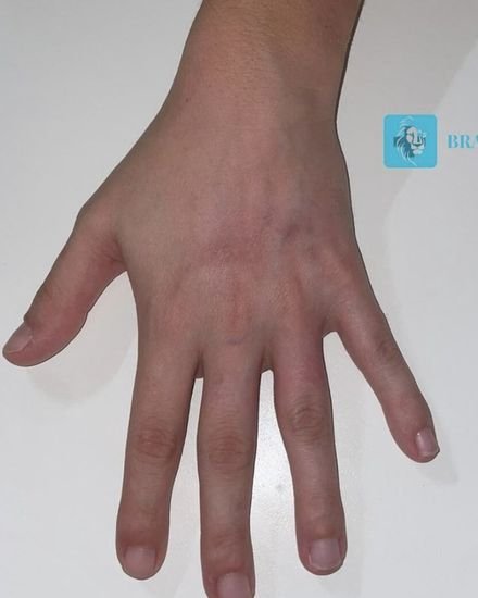 After — Nursing care for a superficial second-degree burn, fully healed after nursing follow-up.